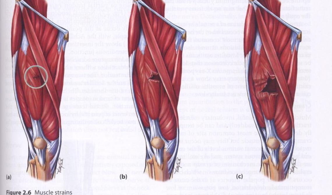 Lesioni muscolari l'incubo dello strappo! Sprint e Sport